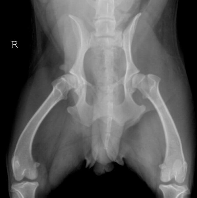 Dysplastic Bilateral OFA Hips