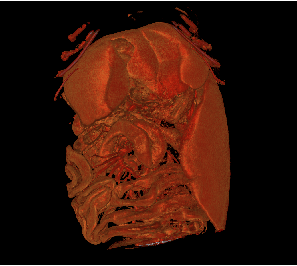 CT scan blood vessels