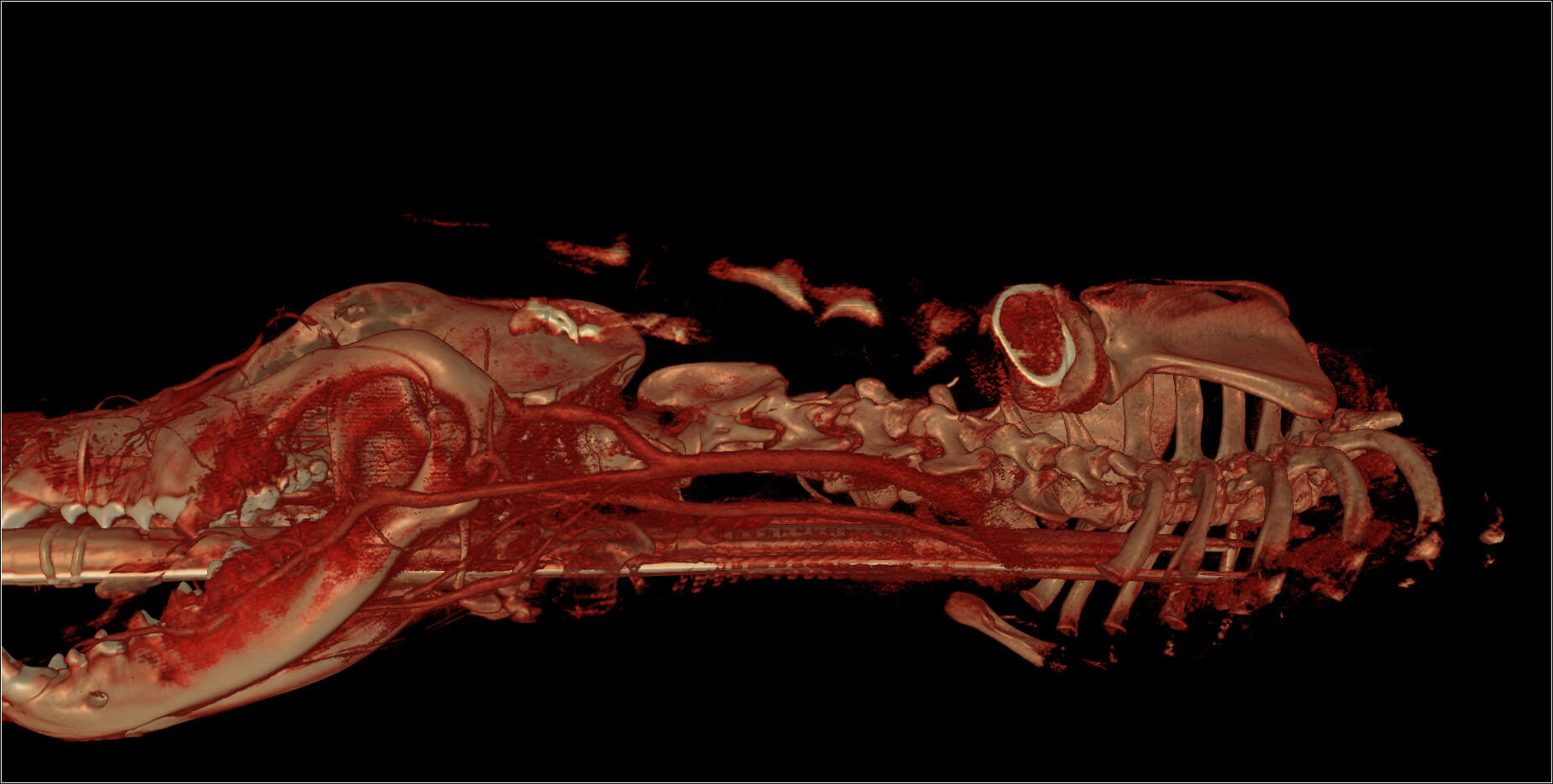 CT scan kidney