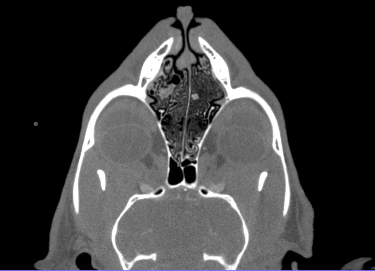 ct brain scan