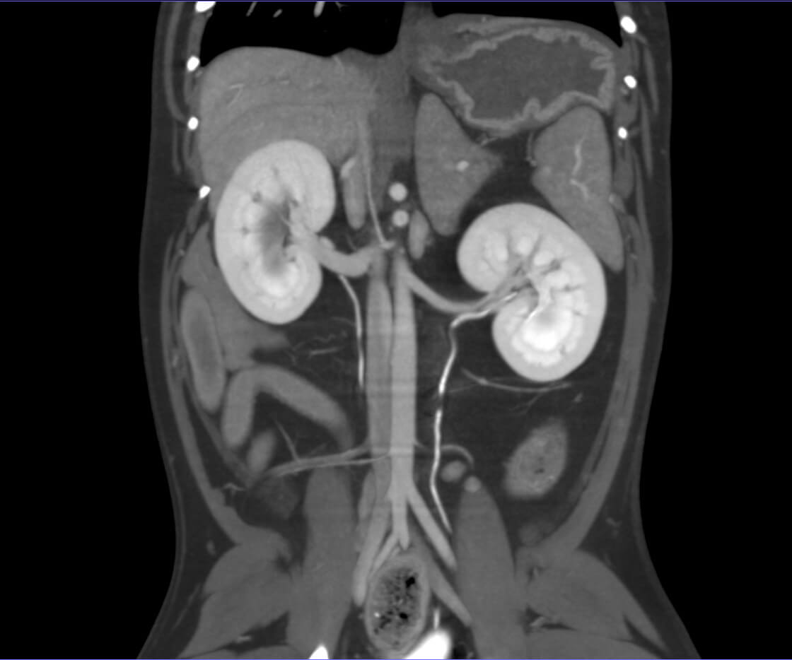 ct internal scan