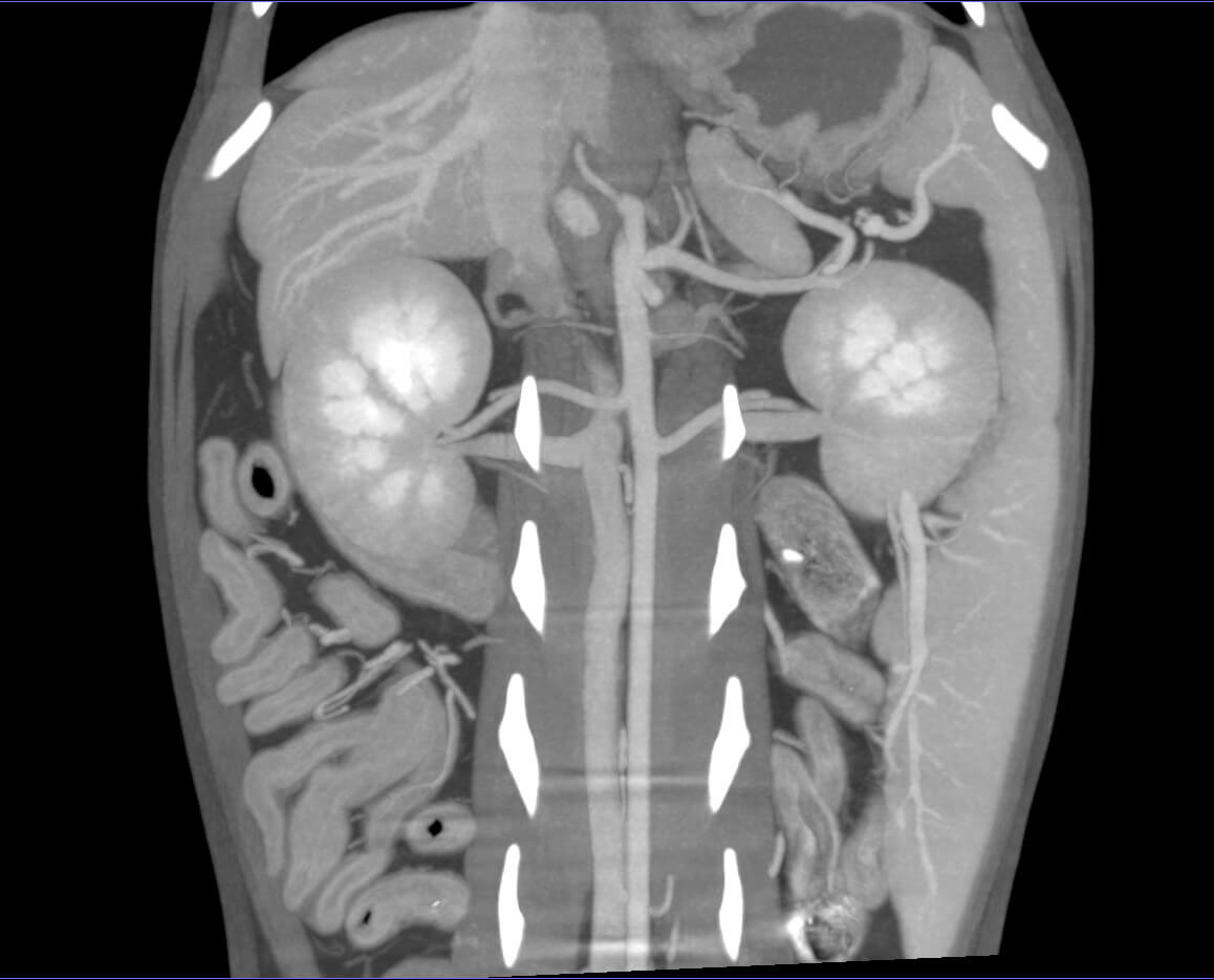 CT Spine