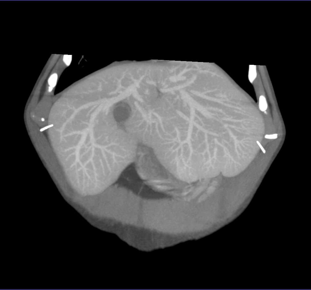 CT scan stomach