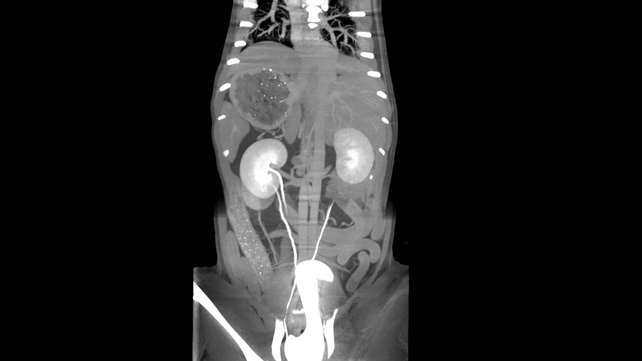CT 2