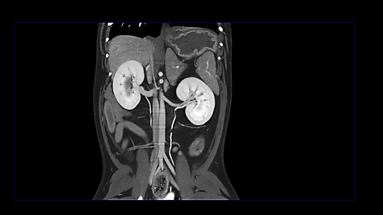 CT 3